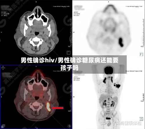男性确诊hiv/男性确诊糖尿病还能要孩子吗-第2张图片