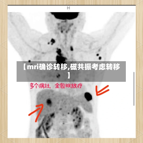 【mri确诊转移,磁共振考虑转移】-第3张图片