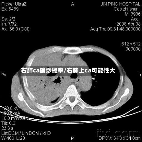 右肺ca确诊概率/右肺上ca可能性大-第2张图片