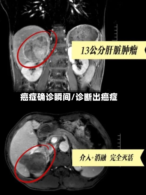 癌症确诊瞬间/诊断出癌症-第2张图片