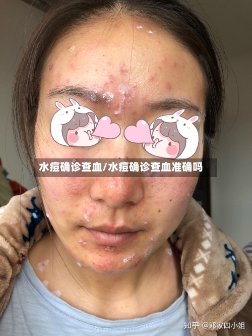 水痘确诊查血/水痘确诊查血准确吗